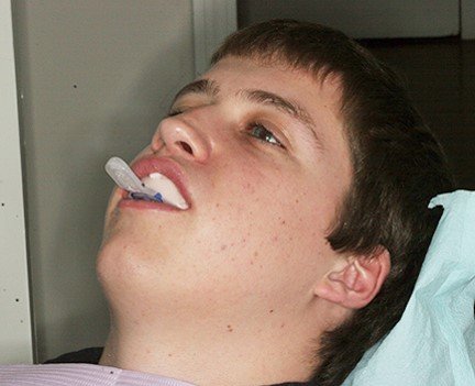Patient Wearing Alginate Impression Tray